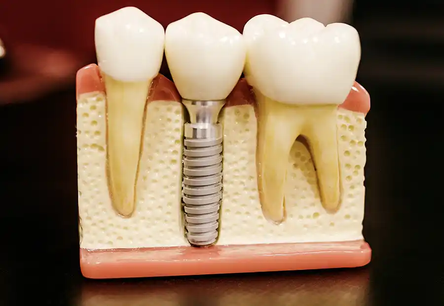 Stafani-Denti-Sani_Implantologie